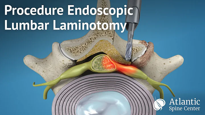 Procedure Endoscopic Lumbar Laminotomy