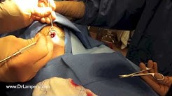 SurgeonCam: How to place a chin implant to create a stronger jawline 