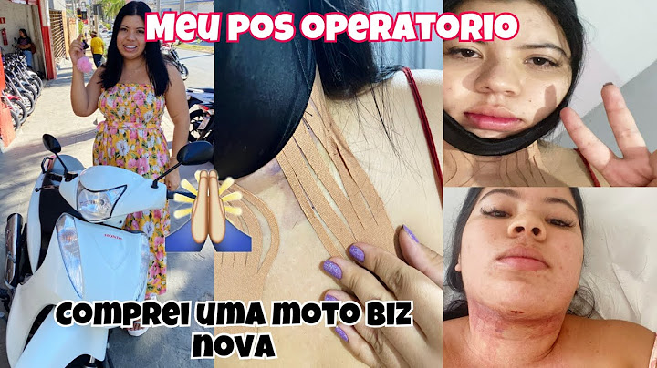 Fiz bichectomia e lipo de papada|primeiros dias pos a cirurgia|recuperaçao e mais