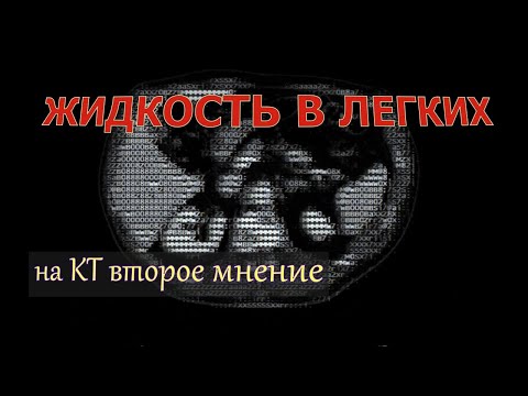 ЖИДКОСТЬ В ЛЕГКИХ, КАНЦЕРОМАТОЗ плевры и ОПУХОЛЬ легкого на КТ расшифровке (второе мнение)