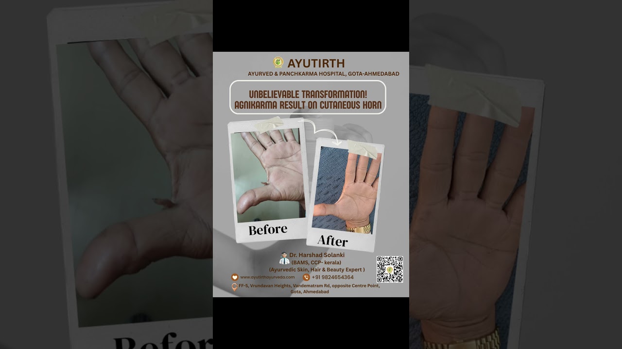 Real patient, real resultAgnikarma Result in Cutaneous Horn