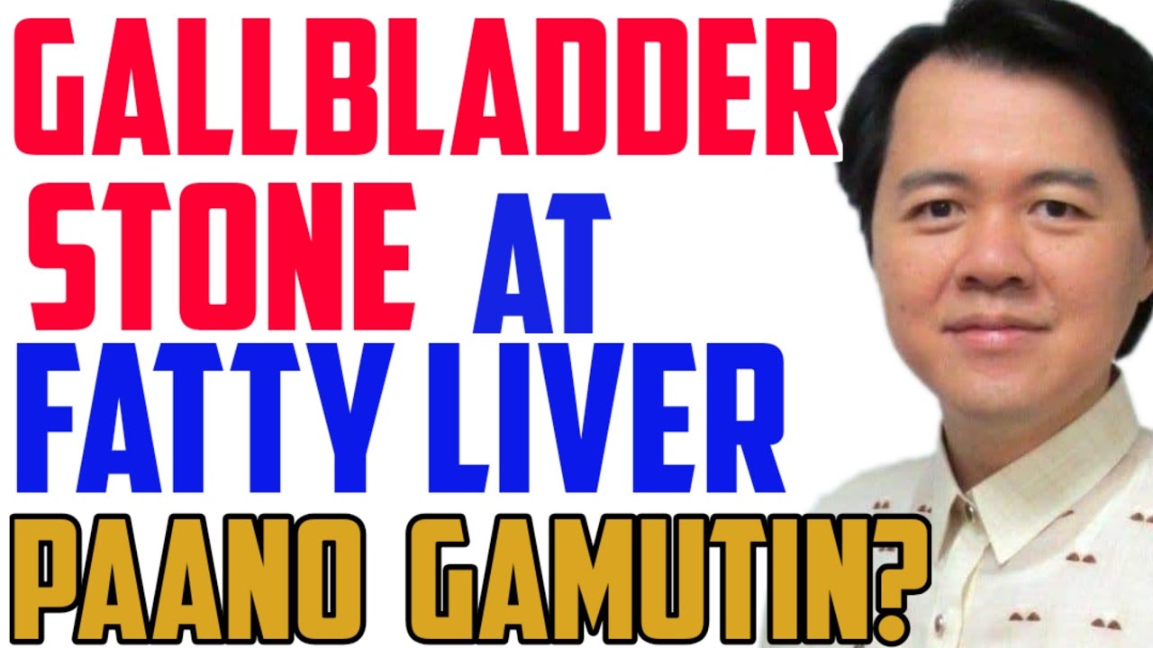GallBladder Stone at Fatty Liver: Paano Gamutin - Payo ni Doc Willie Ong #130