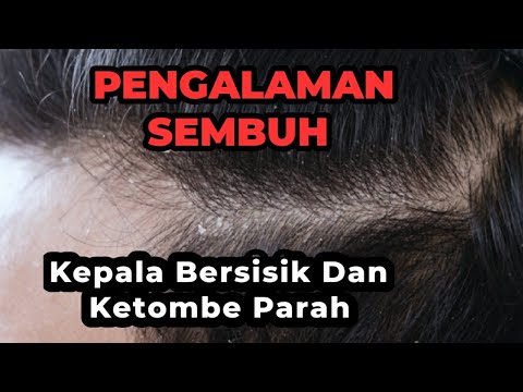 Video: Pengelupasan Untuk Kulit Kepala: Manfaat, Cara, Produk, Dan Banyak Lagi