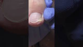 #music #ingrown #relaxing #satisfyingvideo #satisfying #relaxingmusic #relax