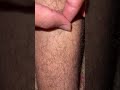 #ingrownhair #massagespa #asmrmassage #satisfying #viralvideo