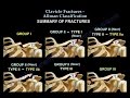 Clavicle Fractures  Classification - Everything You Need To Know - Dr. Nabil Ebraheim