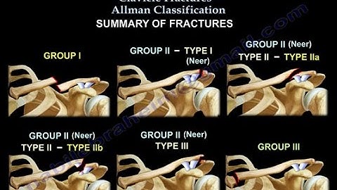 Clavicle Fractures  Classification - Everything You Need To Know - Dr. Nabil Ebraheim