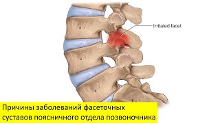 Причины заболеваний фасеточных суставов поясничного отдела позвоночника