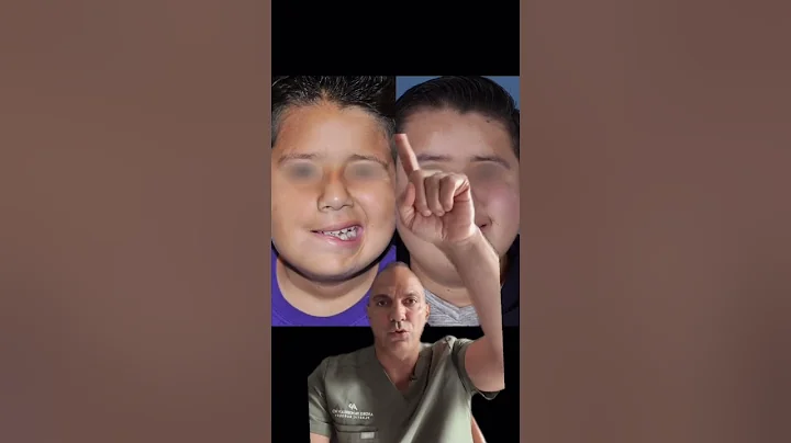 Plastic Surgeon Explains the Temporalis Smile Lift to Treat Facial Paralysis