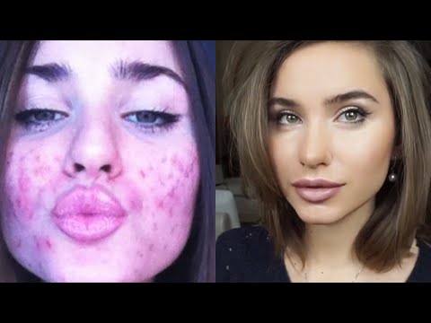 Как Я Избавилась От Прыщей /Акне/Чистая Кожа