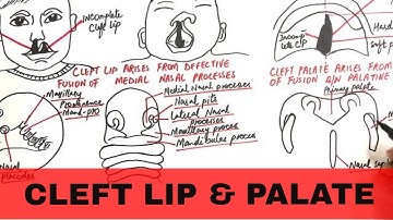 Cleft Lip and Palate - Pathophysiology, Causes & Management