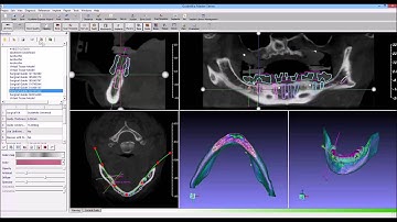dental implant software guidemia overview