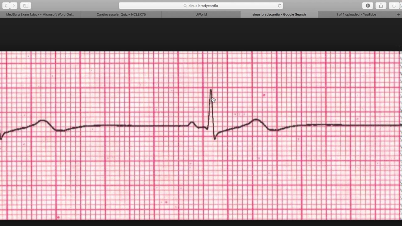 Sinus Bradycardia 