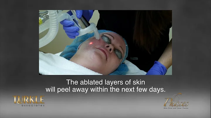 Micro Laser Peel - Facial Rejuvenation in Indianap...