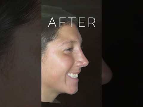 Video thumbnail: Amazing Nose Job Results: Before and After Photos #nosejobs · Dr. Anthony Corrado