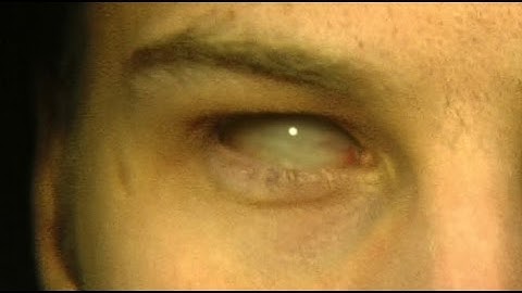 55 - Eye Replacement