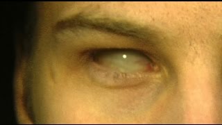 55 - Eye Replacement