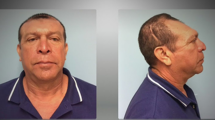 Inesperada pesadilla: A este hombre le tuvieron que reconstruir el rostro tras una afección nasal