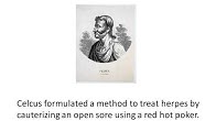 How to Treat Herpes
