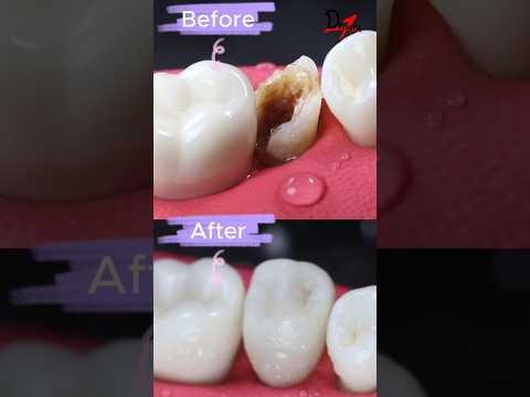 Root Canal Treatment Or Extraction? #rootcanal #rct #asmr #satisfying