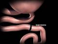 Laparoscopic Gastric Bypass Surgery - Texas Laparoscopic Consultants