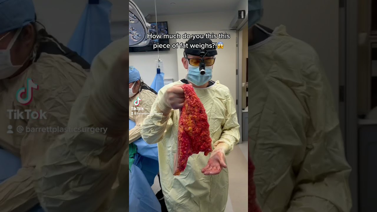 How Much Do You Think This Piece Of Fat Weighs Plasticsurgery Removal Barrettplasticsurgery