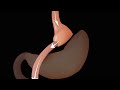 Robotic Bariatric Surgery | Nucleus Health
