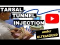 Tarsal tunnel  injection under ultrasound