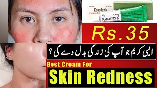 Best Cream For Face Redness | Skin Redness | Kenadex N Cream | Beauty Facts