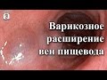 "На приеме у врача" Выпуск 8 - Варикозное расширение вен пищевода