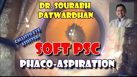 Com 63 Soft cataract -Phacoaspiration of PSC (posterior subcapsular)  Dr Sourabh Patwardhan