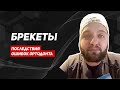 Брекеты. Что нужно знать, чтобы не испортить все зубы? Что лучше брекеты или элайнеры?