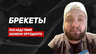 Брекеты. Что нужно знать, чтобы не испортить все зубы? Что лучше брекеты или элайнеры?