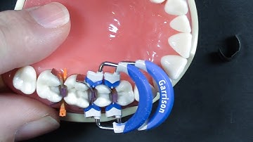 Top 5 Questions: #1 | Back-to-back Class IIs