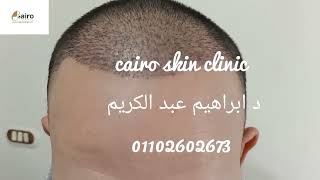 زراعه الشعر بالاقتطاف لمقدمه فروه الراس والشكل بعد 10 ايام بعد سقوط القشور : د ابراهيم عبد الكريم