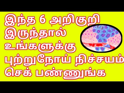 இந்த அறிகுறிகள் இருந்தால் நிச்சயம் கேன்சர் தான் செக் பண்ணுங்க