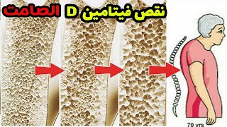 أعراض و علامات نقص فيتامين D د لم تكن تعلمها !