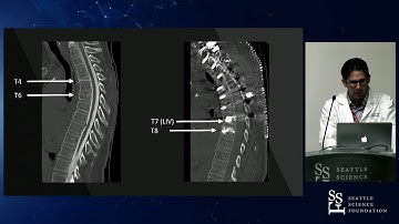 Bone Density and Preoperative Surgical Decision Making - Swedish Neuroscience Institute
