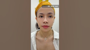 NÂNG TẦNG MẶT GIỮA BẰNG KĨ THUẬT MDCODES #bacsihakhotinh #lamdep #beauty