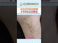 わきが手術の思わぬ代償　悩む前に知ってほしい治療の真実 #shorts