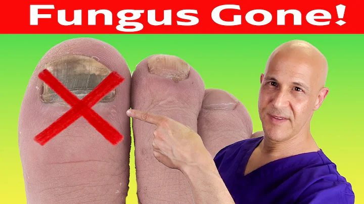 Toe Nail Fungus Cured With Simple Home Remedy (No Medication)  Dr. Mandell