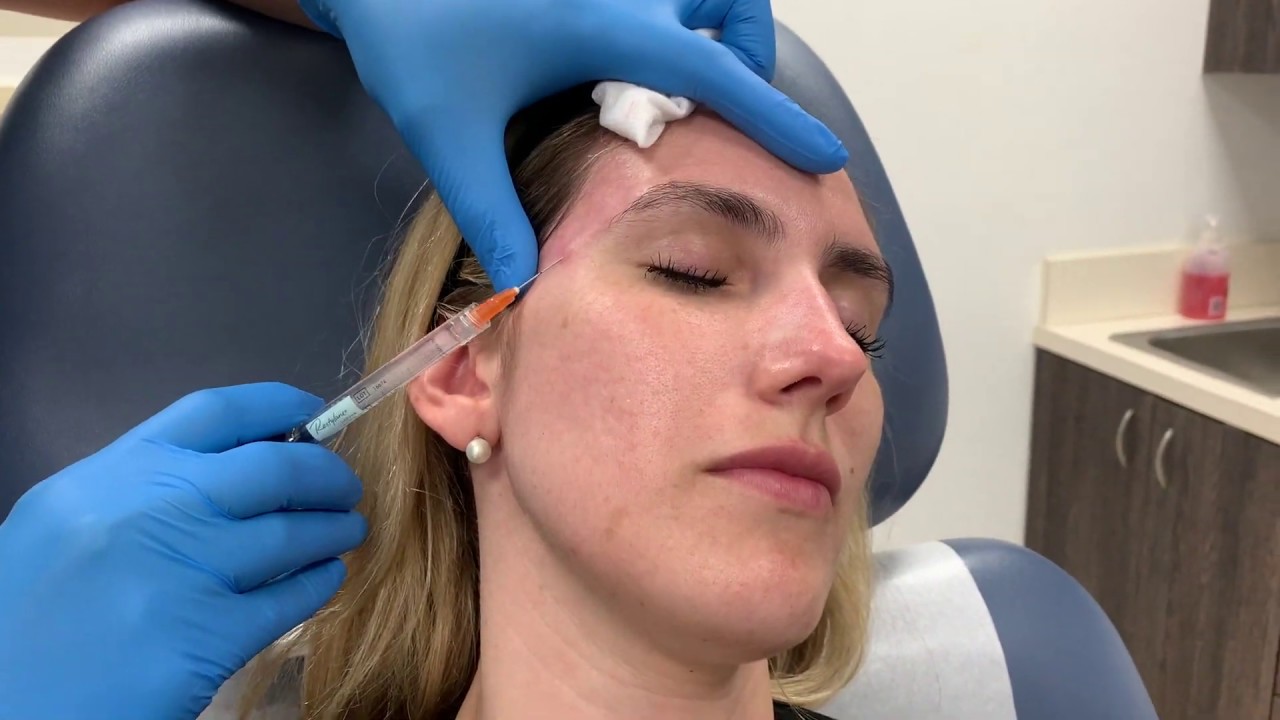 Treating temple volume loss using dilute Restylane Defyne and a