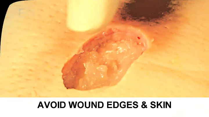 Enzymatic Debridement Demonstration- Understand Wound Care