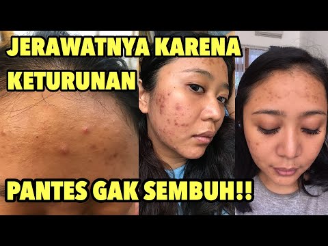 View Cara Menghilangkan Jerawat Faktor Keturunan