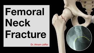 Femoral neck fracture - applied anatomy