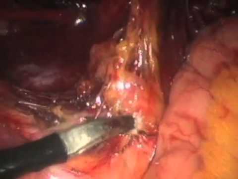 Lymph Node Dissection Para-aortic Laparoscopic - YouTube