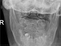 Odontoid fracture