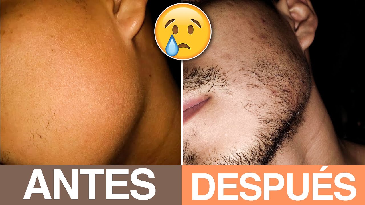 TOP de MALOS resultados con MINOXIDIL 😓