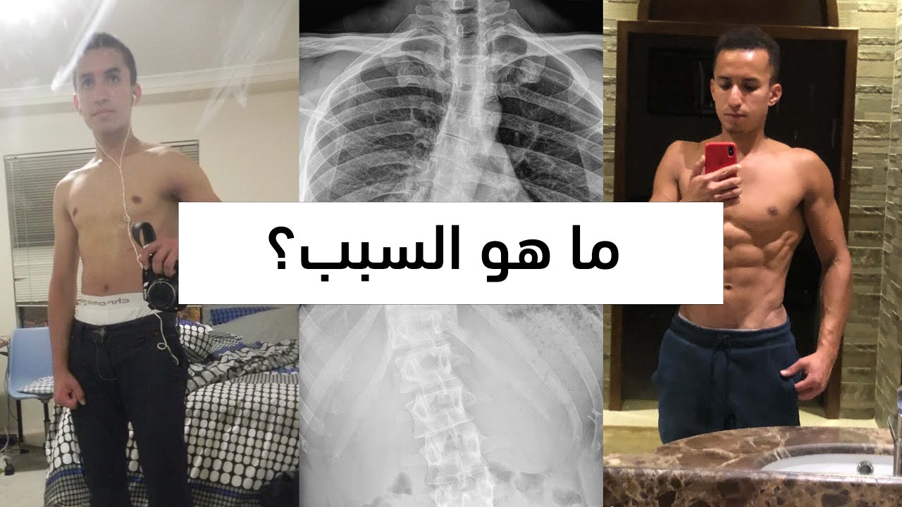 ليش بديت أمارس الرياضة يومياً ؟ | قصتي مع الجنف