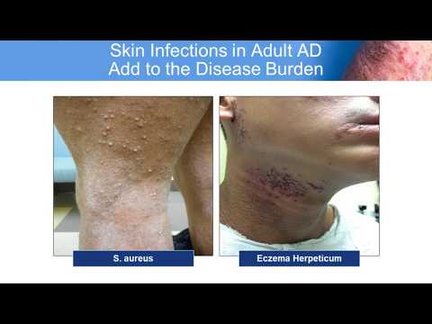 Video: Atopic Dermatitis. Psychosomatics Ng Neurodermatitis